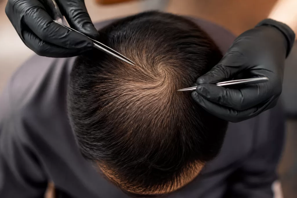 Crown Hair Transplant Swirl: Vertex Graft Density, Angles, and Why the Crown Consumes More Follicles