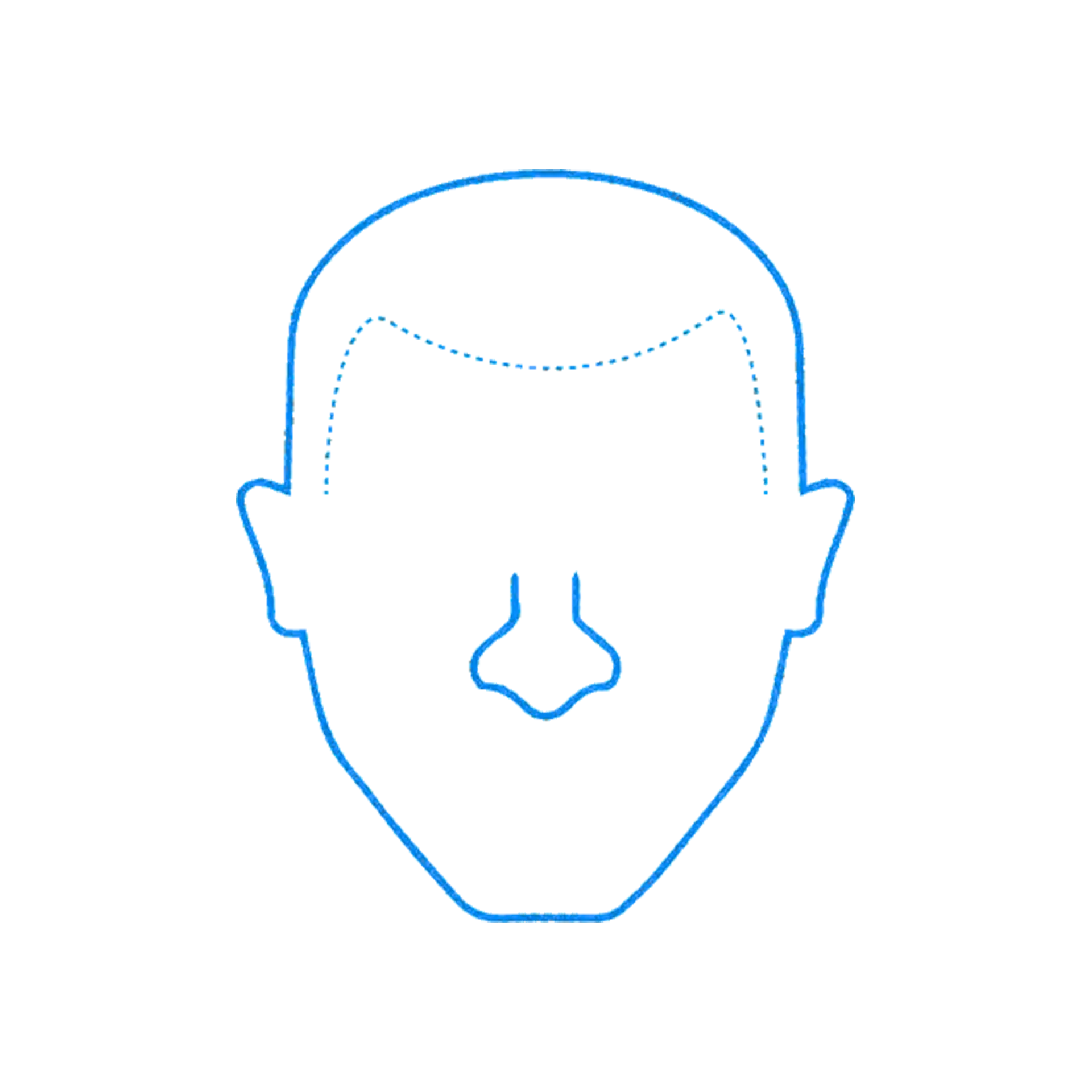 Receding Hairline Reconstruction