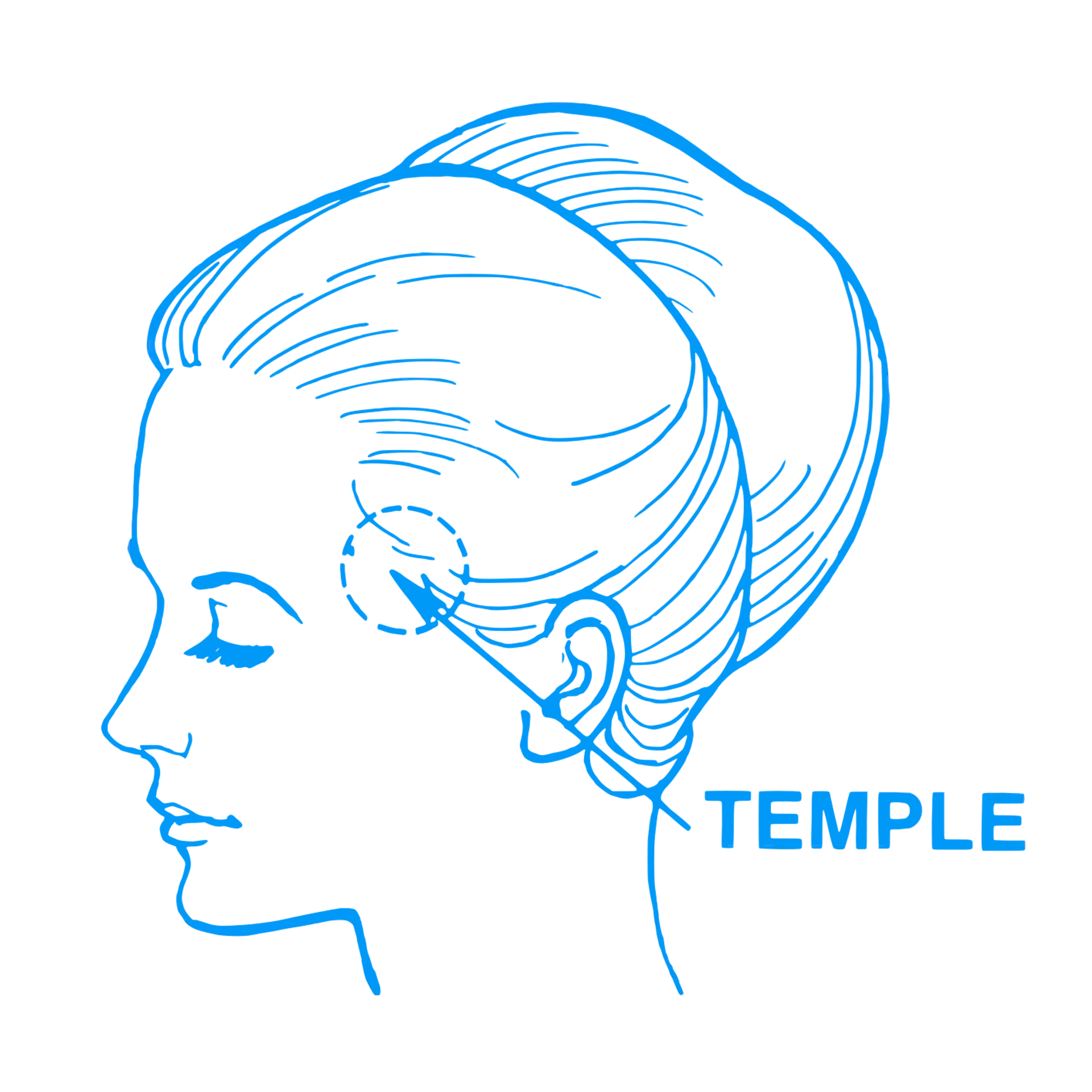 Temple Hair Transplant