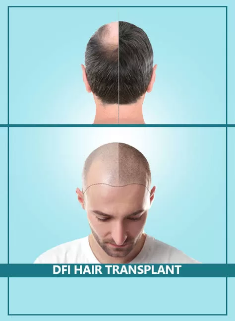 iGraft hair transplant before and after patient result