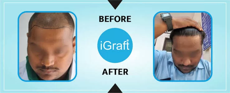 Hair transplant before and after results of an iGraft patient showing restored hairline density
