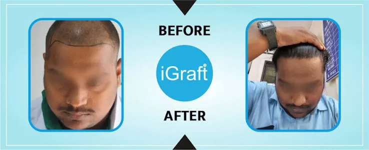 iGraft doctor performing a hair restoration injection treatment